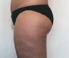 cellulite treatment long island after